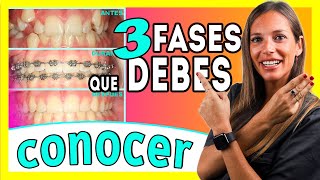 Brackets proceso 𝗠𝗘𝗦 𝗮 𝗠𝗘𝗦 📆 Las ③ 𝐄𝐓𝐀𝐏𝐀𝐒 del TRATAMIENTO de Ortodoncia  Te lo explico ✅ＦÁＣＩＬ [upl. by Erina]