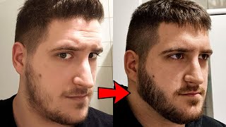 6 month minoxidil transformation thanks Derek for the advice [upl. by Yuk]