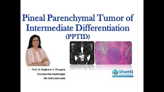 Pineal Parenchymal Tumor of Intermediate Differentiation [upl. by Aiduan954]