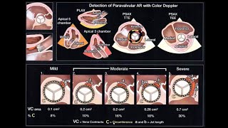 Echocardiographic Assessment of Prosthetic Valves [upl. by Pavel]