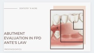 ABUTMENT SELECTION IN FPD [upl. by Oliana466]