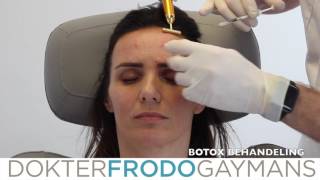 Botox behandeling frons voorhoofd en kraaienpootjes [upl. by Reede781]