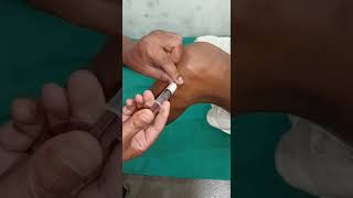 IntraArticular injection How to inject knee joint [upl. by Nnovahs]