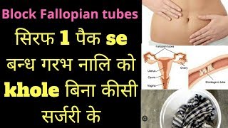 fellopian tube blockage in hindi  fellopian tube blockage treatment heenhaealth [upl. by Nnylhsa181]