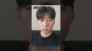 12 months post op Male Double Jaw Surgery in Korea [upl. by Tierell96]