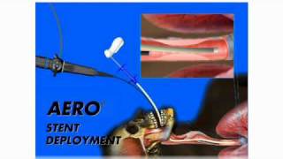 Flexible Bronchoscopy Tracheobronchial AERO® Stent Placement [upl. by Aicena]