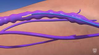 Radiofrequency Ablation of the Great Saphenous Vein  treatment of Varicose Veins with RFiTT [upl. by Otrebmal666]