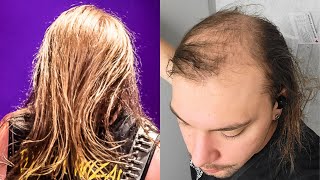 FRONTMAN TELLS ALL On Losing His Hair BALDING [upl. by Stelmach]