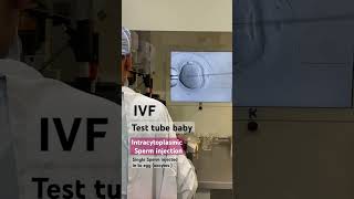 IVFICSI injecting sperm into egg create an embryo ivf infertility patient happy asianivf [upl. by Drehcir593]