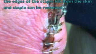 Removing skin staples [upl. by Waldner]