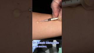 Mantoux Test  Tuberculin Skin Test doctor aiims neet academic mbbsmotivation [upl. by Sirred]