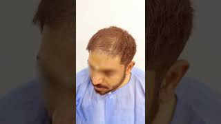 Incredible Hair Transplant Before amp After Dr Amit Kerure Hair Transplant Clinic Navi Mumbai [upl. by Ahsenyl866]