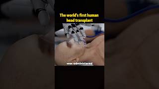 The world’s first human nead transplanthead change techical success youtube foryou fyp [upl. by Eirehs]