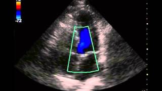 Echo Appearance of Aortic Regurgitation or Insufficiency [upl. by Ehsom25]