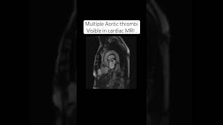 Aortic thrombi  cardiac MRI heart heartattack medstudent mri cardiology cardiothoracic [upl. by Paddy]