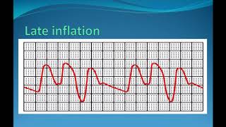 Asuhan Keperawatan Pasien dengan IABP Intra Aortic Ballon Pump [upl. by Hathaway]