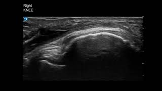 Knee Ultrasound Infrapatellar Bursitis Aspiration Part 3 [upl. by Hamehseer52]