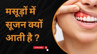 मसूड़ों में सूजन क्यों आती है   जिंजिवाइटिस क्या है   Gingivitis in Hindi [upl. by Nerhe101]