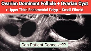 Ultrasound Dominant Follicle and Ovarian Cyst  Small Endometrial Polyp [upl. by Lubba]