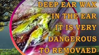 Ear Wax Removal  DEEP Ear Wax In The Ear It Is Very Dangerous To Removed [upl. by Julianne]