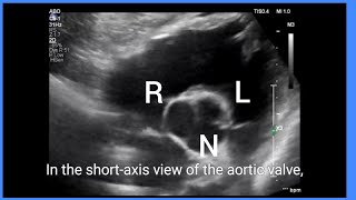 Short axis view of aortic valve subcostal view ultrasound imaging echocardiography [upl. by Anahir]