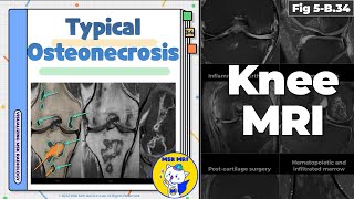 Fig 5B34 Typical Osteonecrosis [upl. by Ahsar]