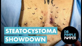 Steatocystoma Showdown [upl. by Albertina936]