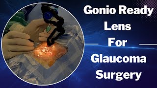 Exploring the Gonio Ready Lens for Glaucoma Surgery [upl. by Anilorak]