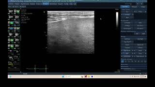 IQ 305 LIVER ULTRASOUND ECHOPAC ANALYSIS HEPATOMA [upl. by Hessler18]