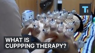 What is cupping therapy [upl. by Maggee]