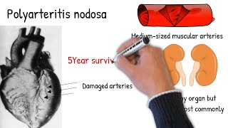 Polyarteritis nodosa made easy [upl. by Gower]