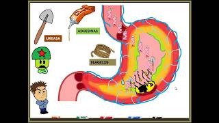 HELICOBACTER PYLORI GASTRITIS [upl. by Weissmann]