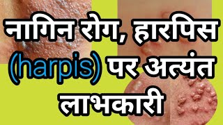 नागिन रोग हार्पिस Harpis पर अत्यंत लाभकारी [upl. by Aidualc]