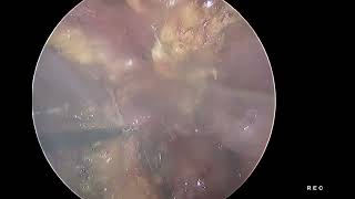 Laparoscopic drainage of a organised right hemorrhagic cyst with adhesiolysis [upl. by Beaner190]