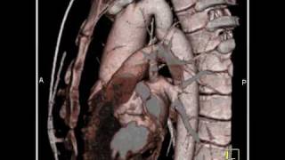 Cardiac Dilated aortic root and aortic stenosis 4 of 6 [upl. by Elleinnad]