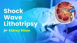 Shock Wave Lithotripsy ESWL for Kidney Stone Treatment  3D Guide [upl. by Murtagh338]