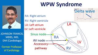 WPW Syndrome [upl. by Kulseth]