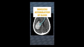 How Intracerebral Haemorrhage Looks on CT Head A Medical Students Guidescience anatomy [upl. by Nwahsal]