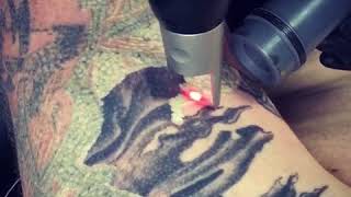 UnTattooU PicoSure Laser Tattoo Removal Half Sleeve [upl. by Cressida]