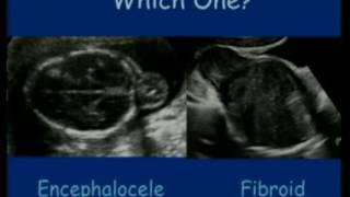 Ultrasound Congenital Anomalies  fetal medicine  fetus [upl. by Lahcsap]