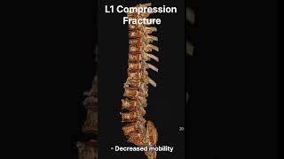 L1 Compression Fracture Understanding Causes Symptoms and Diagnosis 제 1요추 압박골절 원인증상진단에 대한 종합적이해 [upl. by Akinor]