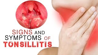 9 Signs and Symptoms of Tonsillitis [upl. by Eymaj835]