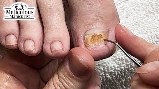 Big Toenail Fix at Home nails satisfying [upl. by Jackqueline]