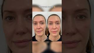 TEAR TROUGH FILLER RESULTS  DR MEDISPA [upl. by Kcirnek]