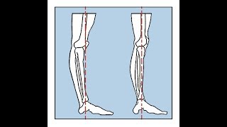 One Minute Anatomy Hyperextension of the knees [upl. by Yzmar]