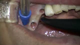 Straumann 2 BLT final set in posterior mandible [upl. by Nilpik190]