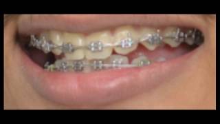 braces time lapse orthodontic treatment [upl. by Rivi]