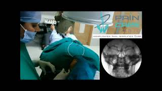 Sphenopalatine Ganglion Treatment Refractory Trigeminal Neuralgia Treatment [upl. by Ytima]