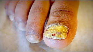 AMAZING TOENAIL FUNGUS amp FOOT RASH Tinea Unguium  Dr Paul [upl. by Moria]