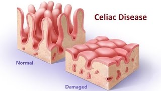 Celiac Disease [upl. by Eyaf]